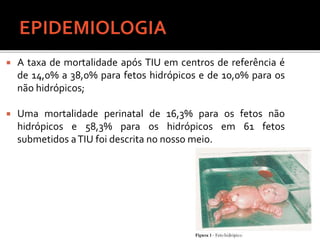  A taxa de mortalidade após TIU em centros de referência é
de 14,0% a 38,0% para fetos hidrópicos e de 10,0% para os
não hidrópicos;
 Uma mortalidade perinatal de 16,3% para os fetos não
hidrópicos e 58,3% para os hidrópicos em 61 fetos
submetidos aTIU foi descrita no nosso meio.
 