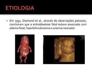  Em 1931, Diamond et al., através de observações pessoais,
concluíram que a eritroblastose fetal estava associada com
edema fetal, hiperbilirrubinemia e anemia neonatal.
 
