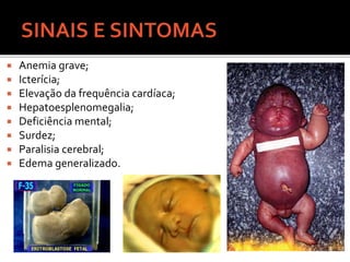  Anemia grave;
 Icterícia;
 Elevação da frequência cardíaca;
 Hepatoesplenomegalia;
 Deficiência mental;
 Surdez;
 Paralisia cerebral;
 Edema generalizado.
 