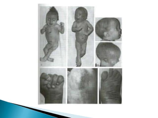 Síndrome de EdwardDistúrbio cromossômico autossômico por cópia extra do cromossomo 18 (trissomia do 18);A síndrome de Edwards é segunda trissomia mais freqüente depois da síndrome de Down (trissomia do 21).
