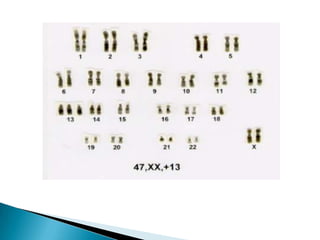 Deformidade facial;Anomalias de extremidades (dedos cerrados, encurvados);Malformações cardíacas, renais, genitais e respiratórias;Lábio leporino e palato fendido;Óbito em 90% dos casos antes do primeiro ano de vida;Maxilar retraído ou ausente.