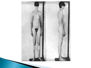 Síndrome de KlinefelterSão indivíduos do sexo masculino que apresentam cromatina sexual e cariótipo geralmente 47,XXY;Eles constituem um dentre 700 a 800 recém-nascidos do sexo masculino, tratando-se, portanto; de uma das condições intersexuais mais comuns. 