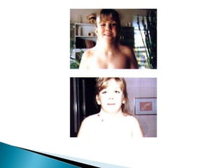 Síndrome de TurnerConstituição cromossômica mais freqüente é 45, X. Não apresentando, portanto, cromatina sexual;Sua ocorrência está em torno de uma em 5000 meninas.