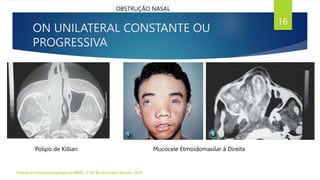 ON UNILATERAL CONSTANTE OU
PROGRESSIVA
Tratado de Otorrinolaringologia da ABROL. 3ª Ed. Rio de Janeiro: Elsevier, 2018.
16
OBSTRUÇÃO NASAL
Pólipo de Killian Mucocele Etmoidomaxilar à Direita
 
