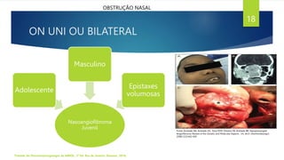 ON UNI OU BILATERAL
Nasoangiofibroma
Juvenil
Adolescente
Masculino
Epistaxes
volumosas
Tratado de Otorrinolaringologia da ABROL. 3ª Ed. Rio de Janeiro: Elsevier, 2018.
18
OBSTRUÇÃO NASAL
Fonte: Andrade NA, Andrade JSC, Silva PDM, Oliveira VB, Andrade BB. Nasopharyngeal
Angiofibroma: Review of the Genetic and Molecular Aspects . Int. Arch. Otorhinolaryngol.
2008;12(3):442-449
 