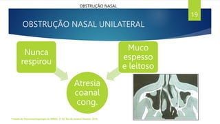 OBSTRUÇÃO NASAL UNILATERAL
Atresia
coanal
cong.
Nunca
respirou
Muco
espesso
e leitoso
Tratado de Otorrinolaringologia da ABROL. 3ª Ed. Rio de Janeiro: Elsevier, 2018.
19
OBSTRUÇÃO NASAL
 