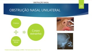 OBSTRUÇÃO NASAL UNILATERAL
Criança
Rinorreia
fétida
Corpo
estranho
Tratado de Otorrinolaringologia da ABROL. 3ª Ed. Rio de Janeiro: Elsevier, 2018.
20
OBSTRUÇÃO NASAL
 