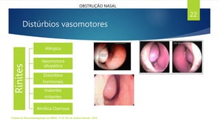 Distúrbios vasomotores
Rinites
Alérgica
Vasomotora
idiopática
Distúrbios
hormonais
Inalantes
irritantes
Atrófica Ozenosa
Tratado de Otorrinolaringologia da ABROL. 3ª Ed. Rio de Janeiro: Elsevier, 2018.
22
OBSTRUÇÃO NASAL
 
