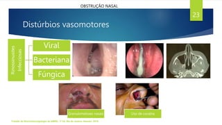 Distúrbios vasomotores
Rinossinusites
Infecciosas
Viral
Bacteriana
Fúngica
Tratado de Otorrinolaringologia da ABROL. 3ª Ed. Rio de Janeiro: Elsevier, 2018.
23
Granulomatoses nasais Uso de cocaína
OBSTRUÇÃO NASAL
 