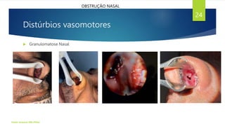 Distúrbios vasomotores
Fonte: Arquivo ORL/FHAJ
24
OBSTRUÇÃO NASAL
 Granulomatose Nasal
 