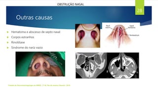 Outras causas
 Hematoma e abscesso de septo nasal
 Corpos estranhos
 Rinolitíase
 Síndrome do nariz vazio
Tratado de Otorrinolaringologia da ABROL. 3ª Ed. Rio de Janeiro: Elsevier, 2018.
28
OBSTRUÇÃO NASAL
 