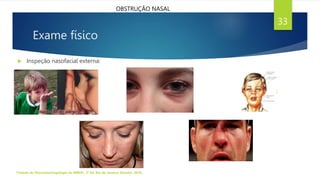 Exame físico
 Inspeção nasofacial externa:
Tratado de Otorrinolaringologia da ABROL. 3ª Ed. Rio de Janeiro: Elsevier, 2018.
33
OBSTRUÇÃO NASAL
 