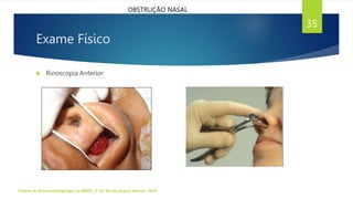 Exame Físico
 Rinoscopia Anterior
Tratado de Otorrinolaringologia da ABROL. 3ª Ed. Rio de Janeiro: Elsevier, 2018.
35
OBSTRUÇÃO NASAL
 