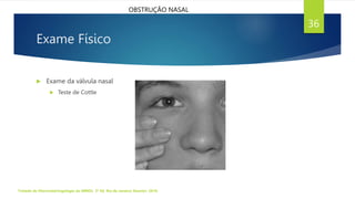 Exame Físico
 Exame da válvula nasal
 Teste de Cottle
Tratado de Otorrinolaringologia da ABROL. 3ª Ed. Rio de Janeiro: Elsevier, 2018.
36
OBSTRUÇÃO NASAL
 