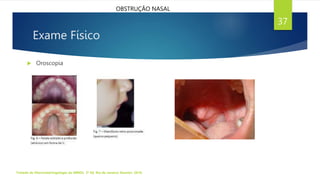 Exame Físico
 Oroscopia
Tratado de Otorrinolaringologia da ABROL. 3ª Ed. Rio de Janeiro: Elsevier, 2018.
37
OBSTRUÇÃO NASAL
 