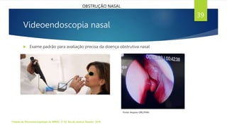 Videoendoscopia nasal
 Exame padrão para avaliação precisa da doença obstrutiva nasal
Tratado de Otorrinolaringologia da ABROL. 3ª Ed. Rio de Janeiro: Elsevier, 2018.
39
Fonte: Arquivo ORL/FHAJ
OBSTRUÇÃO NASAL
 