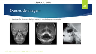 Exames de imagem
 Radiografia de seios da face, cavum: sensibilidade moderada
Tratado de Otorrinolaringologia da ABROL. 3ª Ed. Rio de Janeiro: Elsevier, 2018.
41
OBSTRUÇÃO NASAL
 
