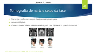 Tomografia de nariz e seios da face
 Exame de escolha para estudo das doenças nasossinusais
 Alta sensibilidade
 Cortes coronais, axiais e reconstruções sagitais com contraste Ev quando indicados
Tratado de Otorrinolaringologia da ABROL. 3ª Ed. Rio de Janeiro: Elsevier, 2018.
42
OBSTRUÇÃO NASAL
 