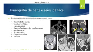 Tomografia de nariz e seios da face
 É útil para identificar anormalidades estruturais como:
• Deformidades septais
• Conchas bolhosas
• Fraturas nasais
• Hipertrofias ósseas das conchas nasais
• Atresia coanal
• Rinossinusites
• Corpos estranhos
• Tumores
Tratado de Otorrinolaringologia da ABROL. 3ª Ed. Rio de Janeiro: Elsevier, 2018.
43
OBSTRUÇÃO NASAL
 