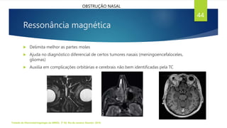 Ressonância magnética
 Delimita melhor as partes moles
 Ajuda no diagnóstico diferencial de certos tumores nasais (meningoencefaloceles,
gliomas)
 Auxilia em complicações orbitárias e cerebrais não bem identificadas pela TC
Tratado de Otorrinolaringologia da ABROL. 3ª Ed. Rio de Janeiro: Elsevier, 2018.
44
OBSTRUÇÃO NASAL
 