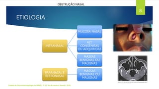 ETIOLOGIA
Tratado de Otorrinolaringologia da ABROL. 3ª Ed. Rio de Janeiro: Elsevier, 2018.
8
OBSTRUÇÃO NASAL
INTRANASAL
MUCOSA NASAL
ALT.
CONGÊNITAS
OU ADQUIRIDAS
MASSAS
BENIGNAS OU
MALIGNAS
PARANASAL E
RETRONASAL
MASSAS
BENIGNAS OU
MALIGNAS
 