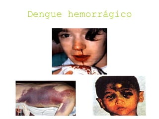 Dengue hemorrágico
 