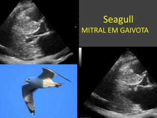 Seagull
MITRAL EM GAIVOTA
 