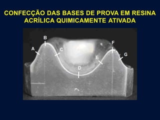 CONFECÇÃO DAS BASES DE PROVA EM RESINA
ACRÍLICA QUIMICAMENTE ATIVADA
 