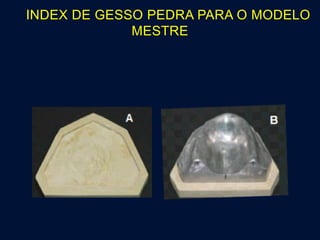 INDEX DE GESSO PEDRA PARA O MODELO
MESTRE
 