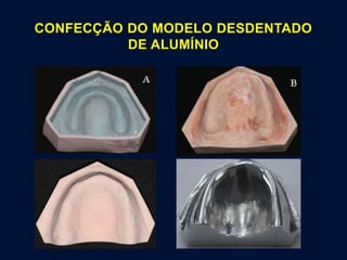 CONFECÇÃO DO MODELO DESDENTADO
DE ALUMÍNIO
 