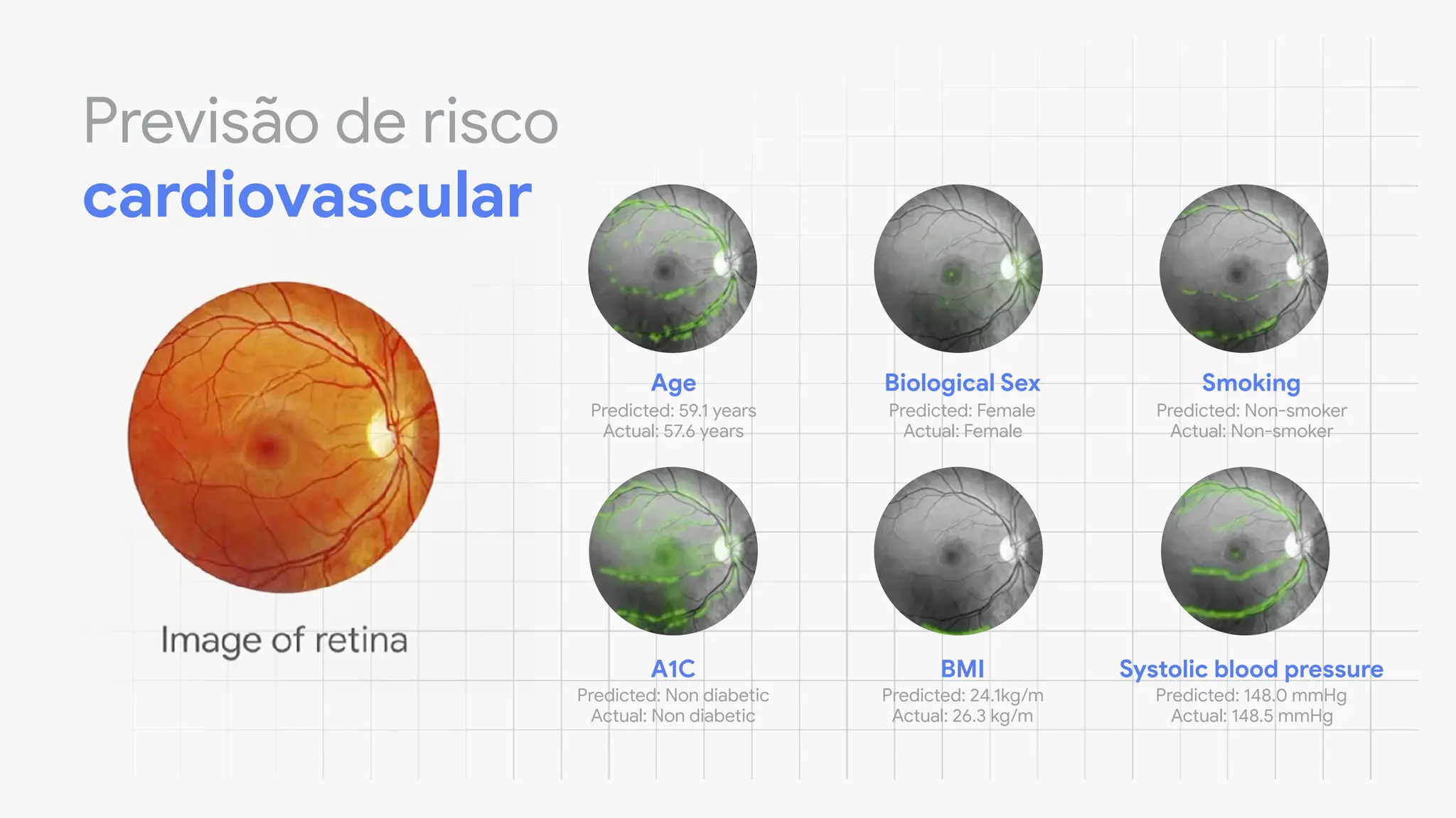 Age
Predicted: 59.1 years

Actual: 57.6 years
Biological Sex
Predicted: Female

Actual: Female
Smoking
Predicted: Non-smoker

Actual: Non-smoker
A1C
Predicted: Non diabetic

Actual: Non diabetic
BMI
Predicted: 24.1kg/m

Actual: 26.3 kg/m
Systolic blood pressure
Predicted: 148.0 mmHg

Actual: 148.5 mmHg
Previsão de risco
cardiovascular
 