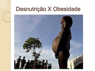 Desnutrição X Obesidade

 