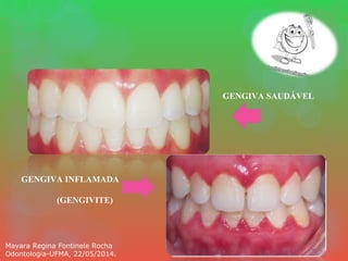GENGIVA INFLAMADA
(GENGIVITE)
GENGIVA SAUDÁVEL
Mayara Regina Fontinele Rocha
Odontologia-UFMA, 22/05/2014.
 