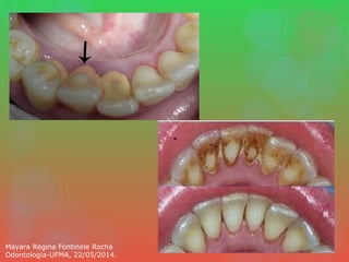 Mayara Regina Fontinele Rocha
Odontologia-UFMA, 22/05/2014.
 