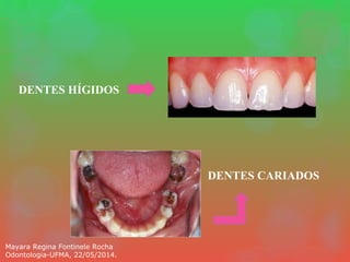 DENTES HÍGIDOS
DENTES CARIADOS
Mayara Regina Fontinele Rocha
Odontologia-UFMA, 22/05/2014.
 