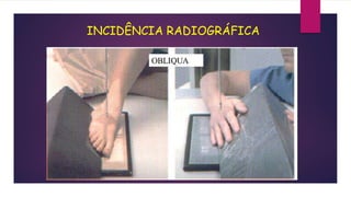 INCIDÊNCIA RADIOGRÁFICA
 
