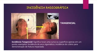 INCIDÊNCIA RADIOGRÁFICA
TANGENCIAL
Incidência Tangencial: Significa tocar uma curva ou superfície apenas em um
ponto; exemplos: Incidência do arco zigomático; incidência do crânio para
demonstração de fratura impactada.
 