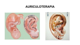 AURICULOTERAPIA
 