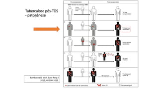 Tuberculose pós-TOS
- patogênese
Bumbacea D, et al. Euro Resp J
2012; 40:990-1013.
 