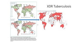 XDR Tuberculosis
 