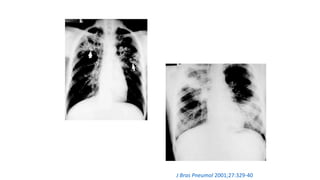 J Bras Pneumol 2001;27:329-40
 