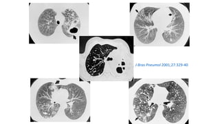 J Bras Pneumol 2001;27:329-40
 