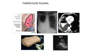 TUBERCULOSE PLEURAL
 