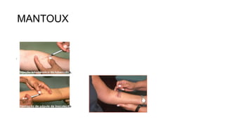 MANTOUX
 