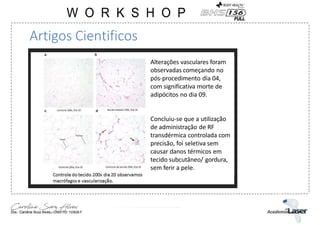 Artigos Cientificos
Alterações vasculares foram
observadas começando no
pós-procedimento dia 04,
com significativa morte de
adipócitos no dia 09.
Concluiu-se que a utilização
de administração de RF
transdérmica controlada com
precisão, foi seletiva sem
causar danos térmicos em
tecido subcutâneo/ gordura,
sem ferir a pele.
 