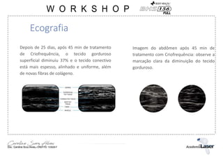 Ecografia
Depois de 25 dias, após 45 min de tratamento
de Criofrequência, o tecido gorduroso
superficial diminuiu 37% e o tecido conectivo
está mais espesso, alinhado e uniforme, além
de novas fibras de colágeno.
Imagem do abdômen após 45 min de
tratamento com Criofrequência: observe a
marcação clara da diminuição do tecido
gorduroso.
 