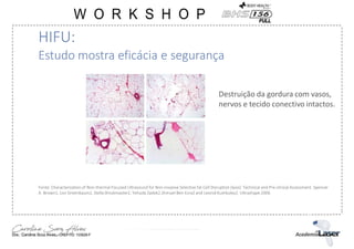 Destruição da gordura com vasos,
nervos e tecido conectivo intactos.
HIFU:
Estudo mostra eficácia e segurança
Fonte: Characterization of Non-thermal Focused Ultrasound for Non-invasive Selective fat Cell Disruption (lysis): Technical and Pre-clinical Assessment. Spencer
A. Brown1, Lior Greenbaum2, Stella Shtukmaster2, Yehuda Zadok2,Shmuel Ben-Ezra2 and Leonid Kushkuley2. Ultrashape 2006
 
