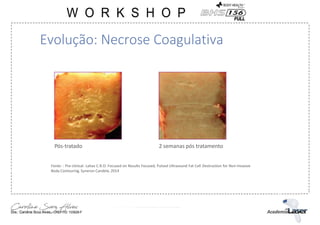Evolução: Necrose Coagulativa
Fonte: : Pre-clinical: Lahav C.R.O. Focused on Results Focused, Pulsed Ultrasound Fat Cell Destruction for Non-Invasive
Body Contouring. Syneron Candela. 2014
Pós-tratado 2 semanas pós tratamento
 