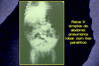 Raios X simples do abdome: pneumonia lobar com íleo paralítico 