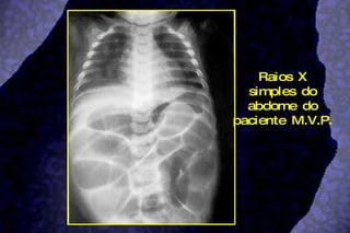 Raios X simples do abdome do paciente M.V.P.  